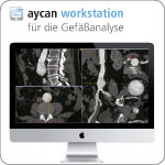 aycan workstation für die Gefäßanalyse